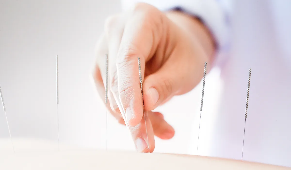 鍼灸施術の画像